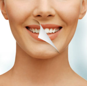 teeth whitening