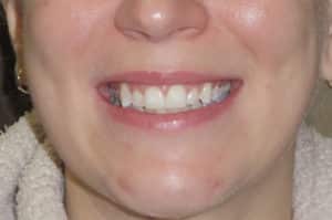 Invisalign