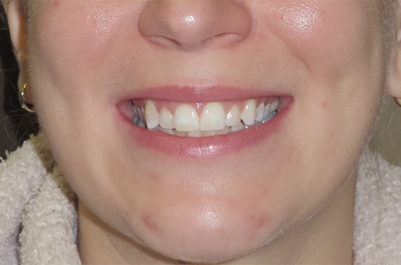 Invisalign