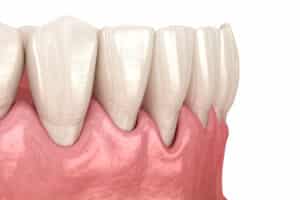 Gum recession process. Medically accurate 3D illustration