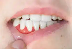 gum disease 300x206.jpeg