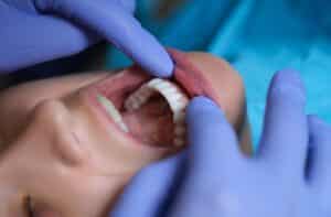 Dental patient opens mouth wide without gagging thanks to relaxation techniques.
